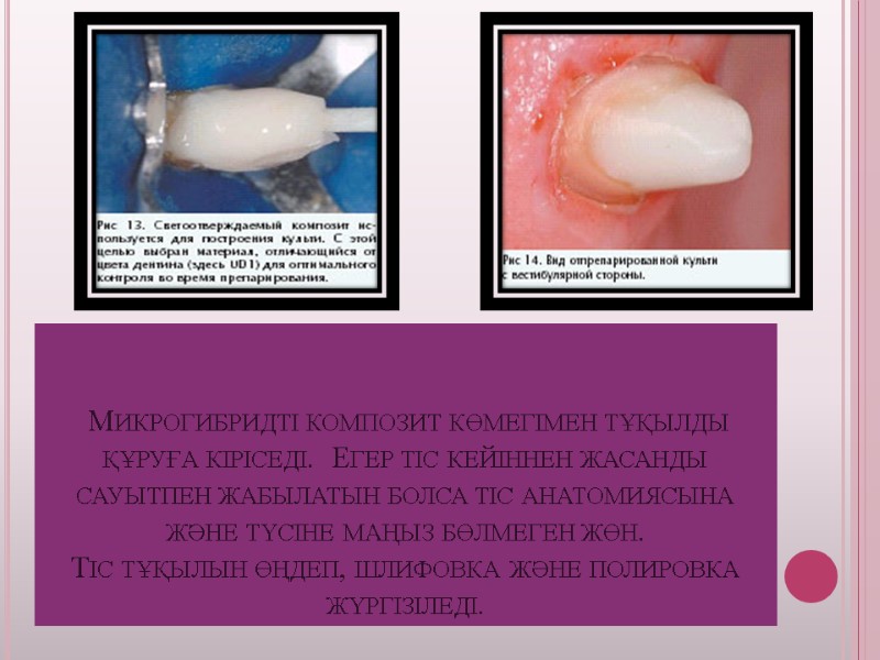 Микрогибридті композит көмегімен тұқылды құруға кіріседі.  Егер тіс кейіннен жасанды сауытпен жабылатын болса